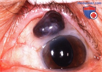 Неопухолевые болезни симулирующие меланому заднего отдела сосудистой оболочки глаза