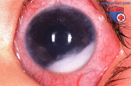 Примеры ретинобластомы напоминающей целлюлит глазницы
