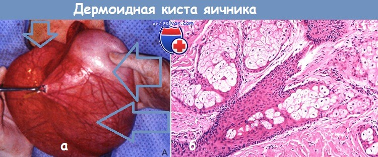 Что такое фенестрация кист яичников thumbnail