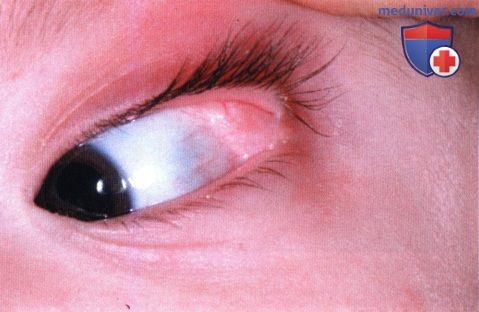 Дермолипома глазницы (липодермоид)