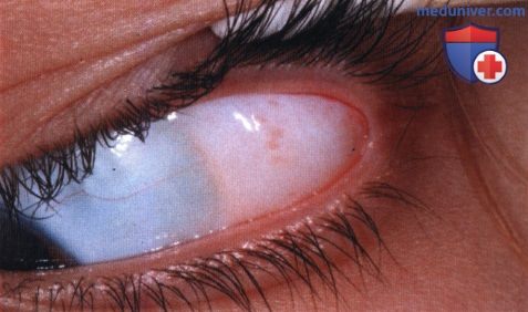 Дермолипома глазницы (липодермоид)