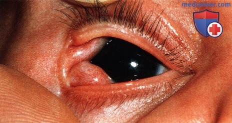 Дермолипома конъюнктивы и глазницы