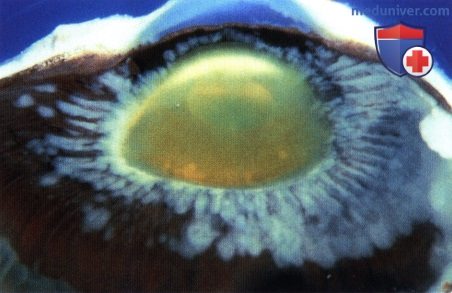 Примеры диффузного роста ретинобластомы