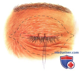 Примеры экзентерации глазницы при опухоли глаза