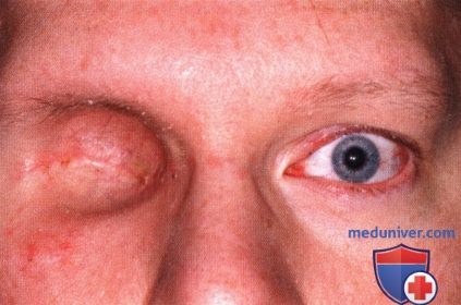 Примеры экзентерации глазницы при меланоме сосудистой оболочки глаза