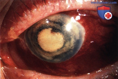 Примеры экзентерации глазницы при меланоме сосудистой оболочки глаза