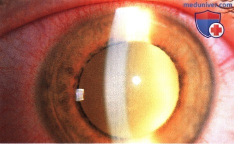 Примеры эндогенного эндофтальмита симулирующего ретинобластому