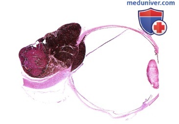 Примеры энуклеации при меланоме хориоидеи