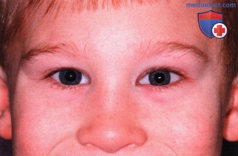 Примеры энуклеации при ретинобластоме