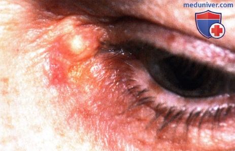 Эпидермоидная киста века глаза (эпидермальная инклюзионная киста)