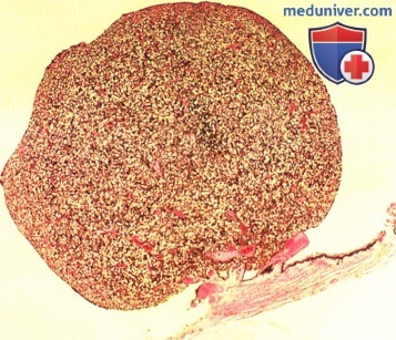 Эпителиома (аденома) пигментного эпителия цилиарного тела