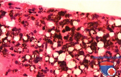 Эпителиома (аденома) пигментного эпителия сетчатки