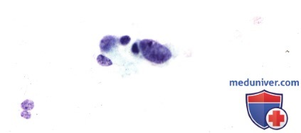 Примеры эпителиомы (аденомы) пигментного эпителия сетчатки из лазеркоагулята