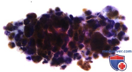 Примеры эпителиомы (аденомы) пигментного эпителия сетчатки из поствоспалительного рубца
