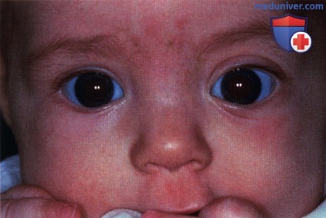Фиброматоз глазницы (миофиброматоз)
