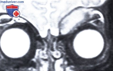 Фиброматоз глазницы (миофиброматоз)