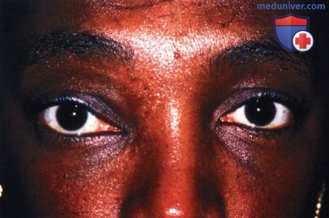 Фиброзная дисплазия глазницы