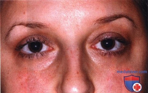 Фиброзная дисплазия глазницы