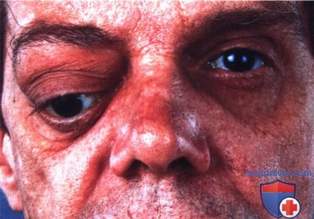 Фиброзная гистиоцитома глазницы