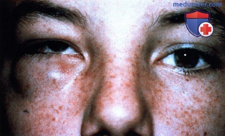 Фиброзные и миксоматозные опухоли века глаза