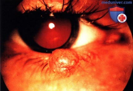 Фиброзные и миксоматозные опухоли века глаза