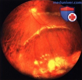 Фотографии первичной вазопролиферативной опухоли глазного дна