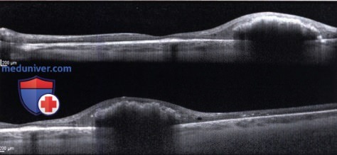 Примеры фотодинамической терапии гемангиобластомы сетчатки