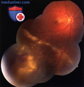 Примеры фотодинамической терапии и криотерапии вазопролиферативной опухоли глазного дна