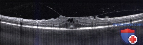 Примеры фотодинамической терапии и криотерапии вазопролиферативной опухоли глазного дна