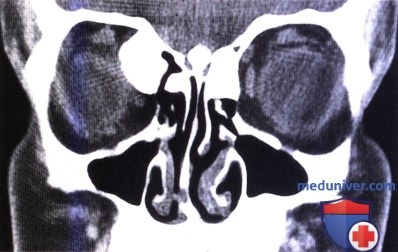 Гамартома пигментного эпителия сетчатки при семейном аденоматозном полипозе и синдроме Гарднера