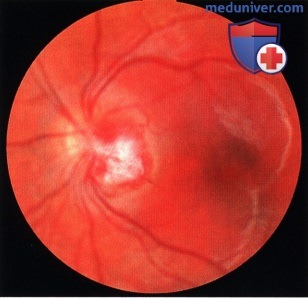 Примеры гемангиобластомы на широком основании диска зрительного нерва
