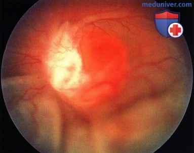 Примеры гемангиобластомы на широком основании диска зрительного нерва