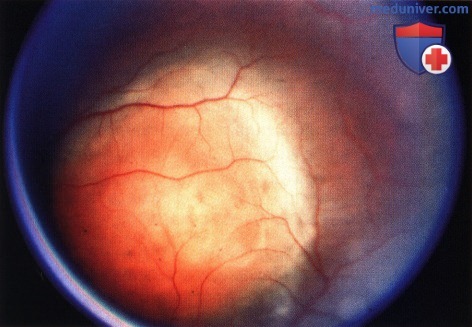 Гемангиоперицитома сосудистой оболочки глаза