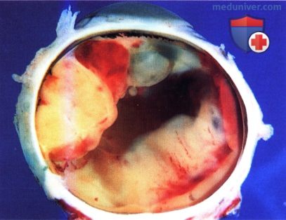 Фиброзная гистиоцитома и примитичная нейроэктодермальная опухоль сосудистой оболочки глаза