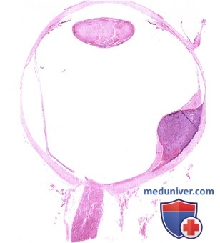 Гистология (патологическая анатомия) меланомы заднего отдела сосудистой оболочки глаза