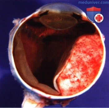 Гистология (патологическая анатомия) меланомы заднего отдела сосудистой оболочки глаза