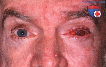 Примеры глаукомы при лимфоме сосудистой оболочки глаза