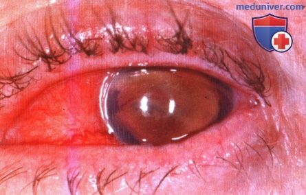 Примеры глаукомы при лимфоме сосудистой оболочки глаза