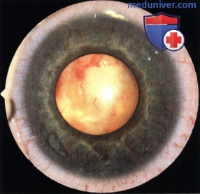 Примеры неоваскулярной глаукомы при ретинобластоме