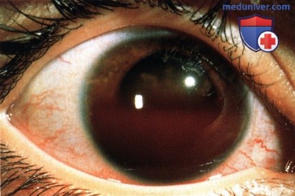 Примеры неоваскулярной глаукомы при ретинобластоме