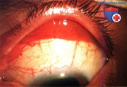 Поражение внутриглазных структур глаза при лейкозе