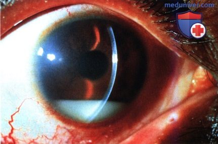 Поражение внутриглазных структур глаза при лейкозе