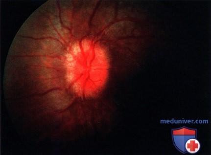 Ювенильная пилоцитарная астроцитома зрительного нерва (глиома зрительного нерва)
