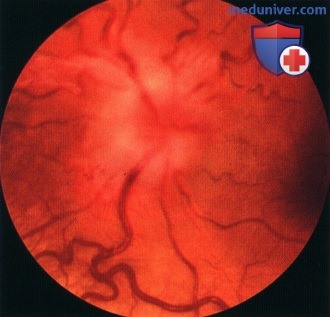 Ювенильная пилоцитарная астроцитома зрительного нерва (глиома зрительного нерва)