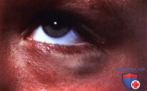 Гломусная опухоль (гломангиома) века глаза
