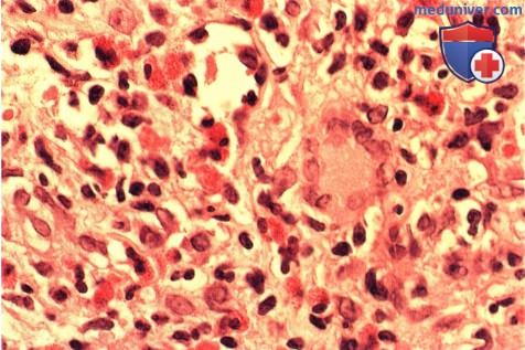 Аллергический гранулематоз Черджа-Стросс, симулирующий опухоль конъюнктивы