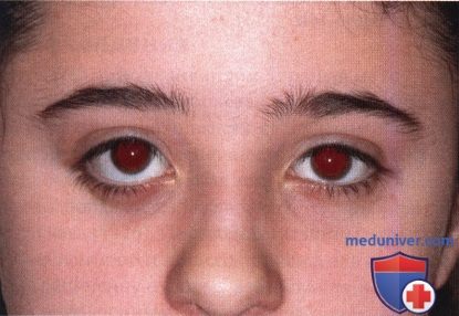 Гранулематоз глазницы с полиангиитом (гранулематоз Вегенера)