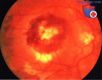 Примеры инфекции глазного дна, симулирующей меланому хориоидеи