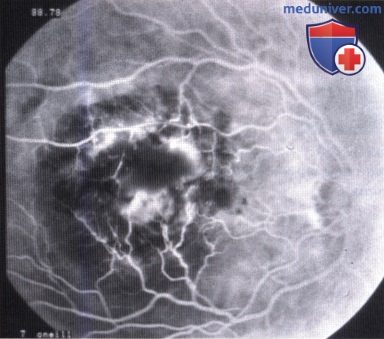 Примеры инфекции глазного дна, симулирующей меланому хориоидеи