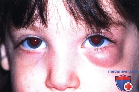 Капиллярная гемангиома глазницы